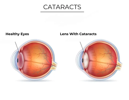 Cataract surgery in Mauritius