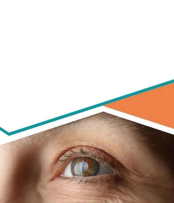 Best Cataract Surgery In Mauritius