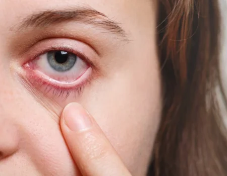 SYMPTOMS OF CORNEAL DISORDERS