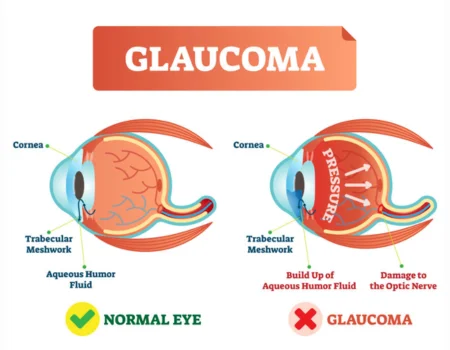 symptoms of Glaucoma